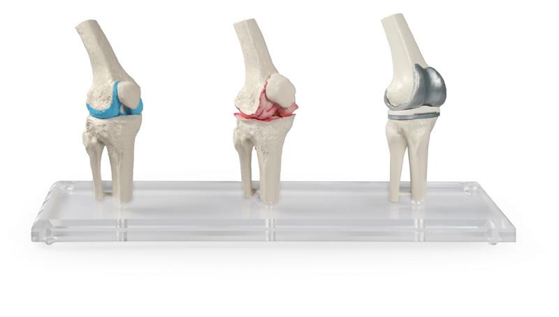 Knie-Implantat-Modell