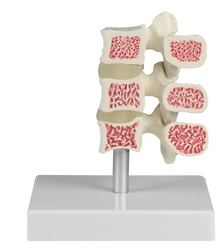 Osteoporose-Wirbel-Modell, 3 Wirbel