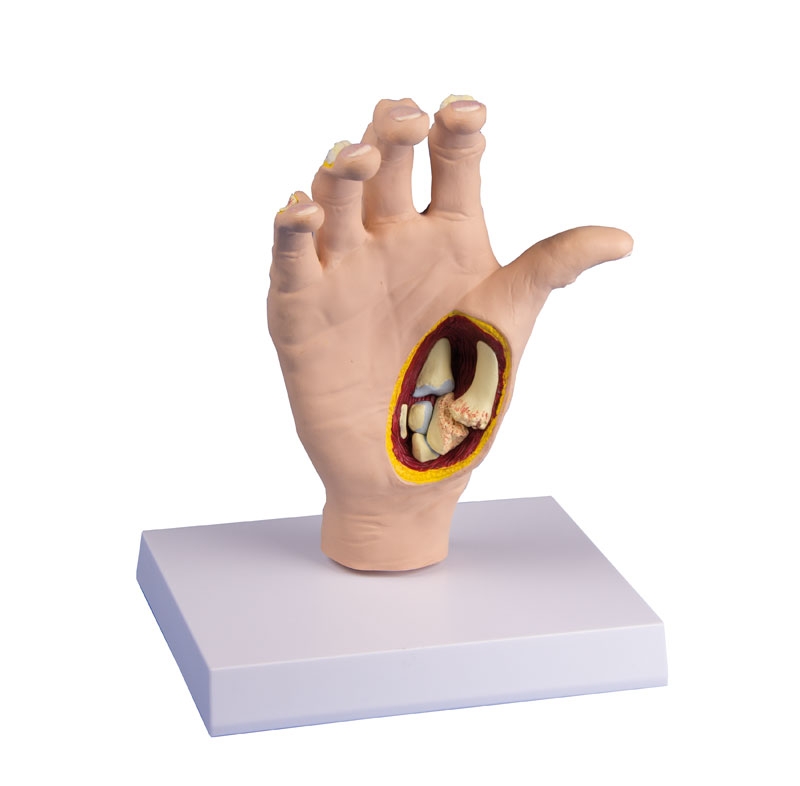 Osteoarthritis (OA) Hand