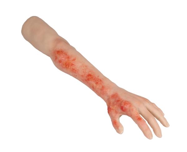 Erler-Zimmer Arm mit Verbrennungen Task-Trainer Erler-Zimmer Arm mit Verbrennungen Task-Trainer
