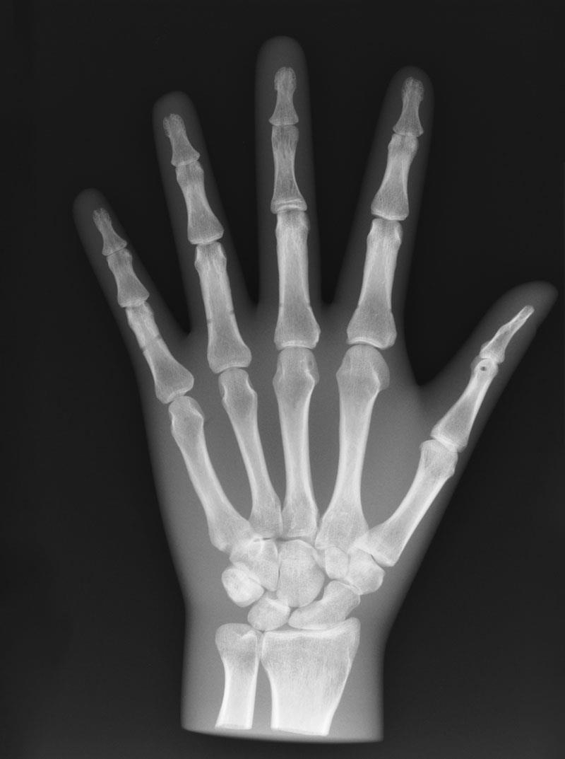 Röntgenphantom Hand, opak