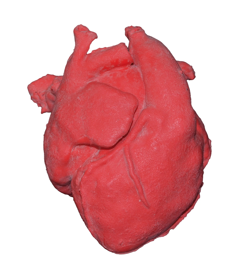 Pädiatrisches Herz mit korrigierter Transposition der großen Arterien (TGA) und Ventrikelseptumdef.