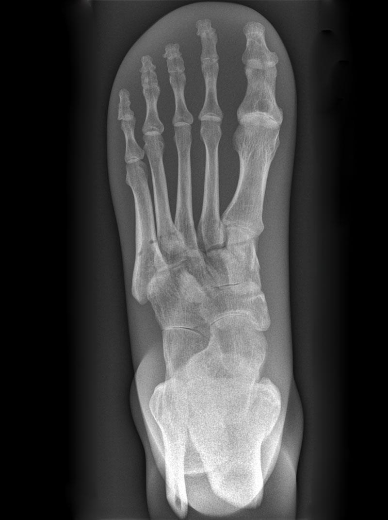 Röntgenphantom Fuß, opak