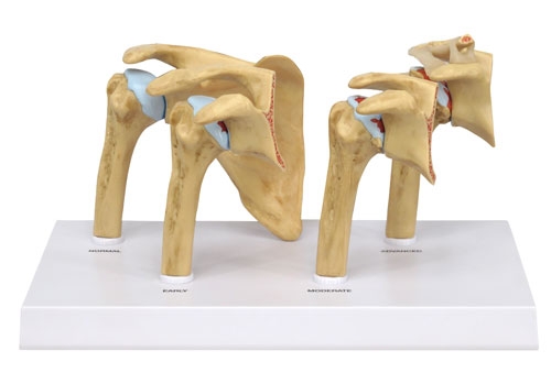 4-Stadien-Osteoarthritis (OA) Schulter