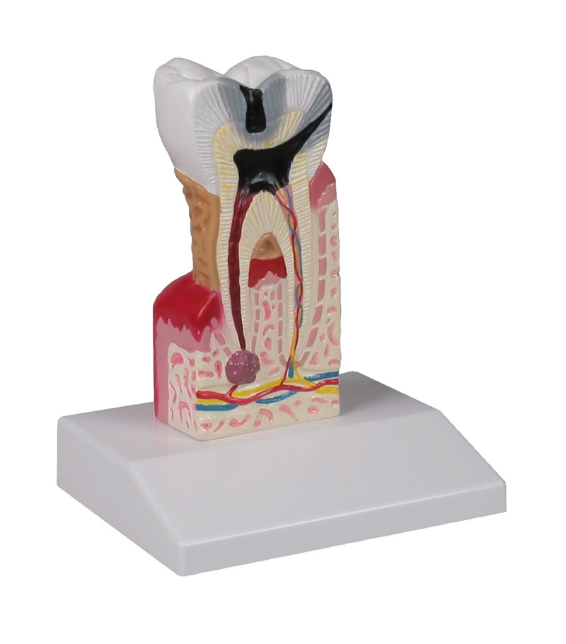 Zahnkariesmodell, 10-fache Größe